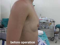 plastic-surgery-breast-augmentation 